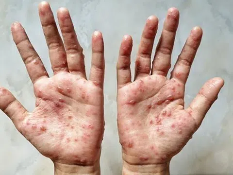 Tp.HCM có ca đậu mùa khỉ đầu tiên