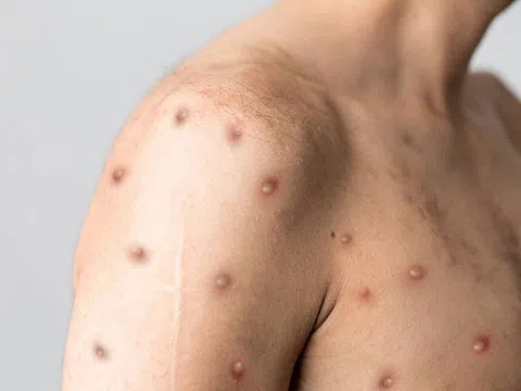 Đại diện Bộ Y tế nói gì về khả năng lây lan đậu mùa khỉ tại Việt Nam?