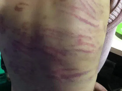 Phó Chủ tịch UBND TP.Hà Nội chỉ đạo xử lý vụ bé 12 tuổi bị mẹ đẻ bạo hành