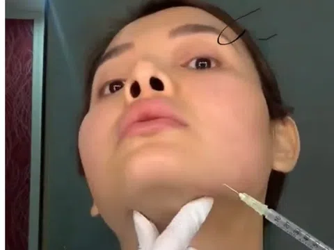 Phương Trinh Jolie gây "sốc" khi chia sẻ hình ảnh tự tay tiêm filler lên mặt