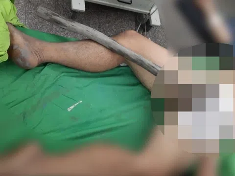 Sập sàn gỗ lúc ngồi tắm, người đàn ông bị cây đâm từ dưới xuyên bụng